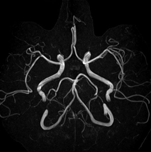 頭部MRA（血管）画像