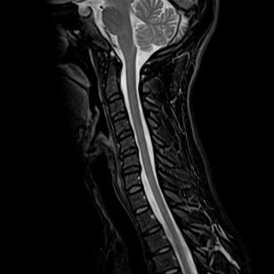 頸椎MRI画像
