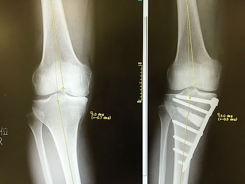 図11）高位脛骨骨切り術（O脚（写真左）をX脚（同右）に矯正する）