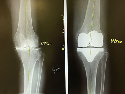 図14）人工膝関節全置換術（関節全体の置換）