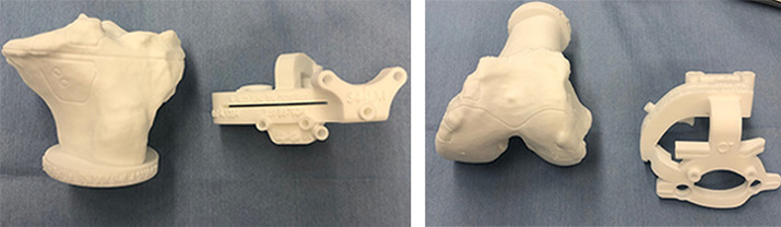 図15）患者さまの膝モデルとそれにあわせたオーダーメイド骨切りガイド