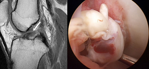 図1-1 MRI：膝前十字靭帯損傷