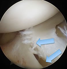 図4）半月板損傷