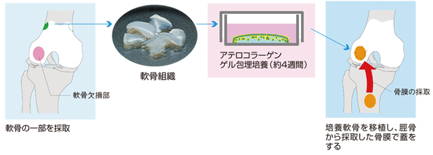 図8-4）自家培養軟骨の移植フロー（膝関節）