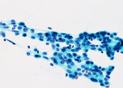 正常あるいは良性：線維腺腫の細胞像のイメージ