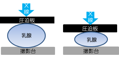 マンモグラフィによる圧迫のイメージ