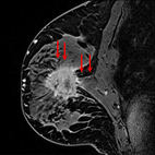 乳がん（進展）のイメージ