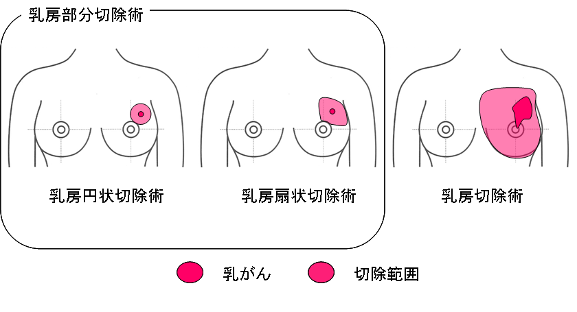 乳房に対する手術のイメージ