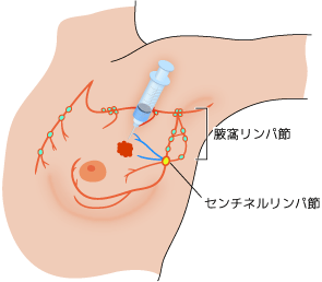 腋窩リンパ節に対する手術のイメージ