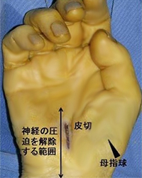 手根管症候群の手術イメージ